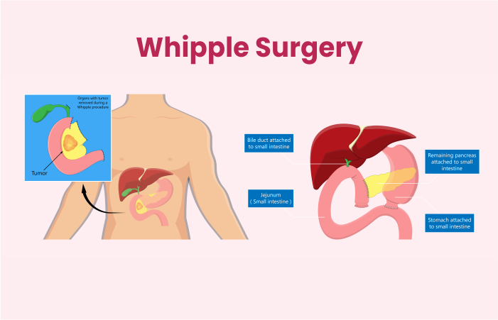 Whipple Surgery