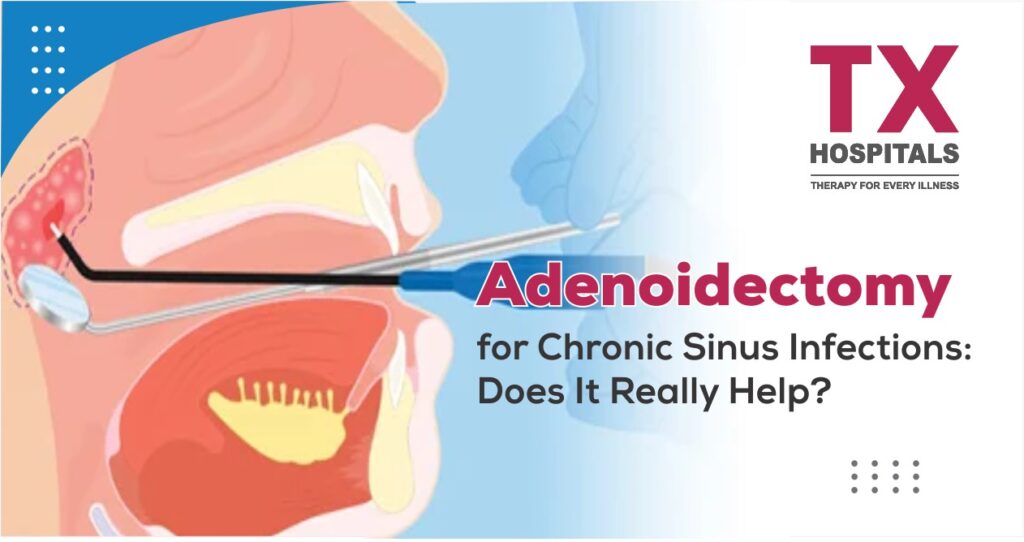 Adenoidectomy for Chronic Sinus Infections